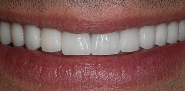 10 Custom Porcelain Veneers