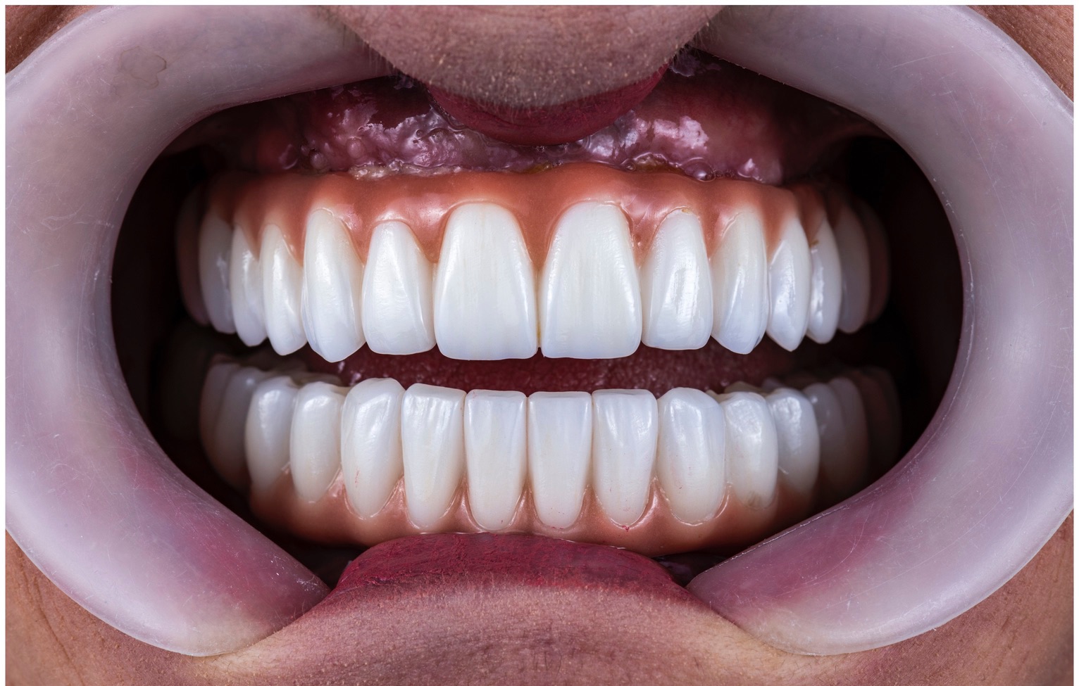 full mouth rehabilitation by crowns veneers and implantsfull mouth rehabilitation by crowns veneers and implants