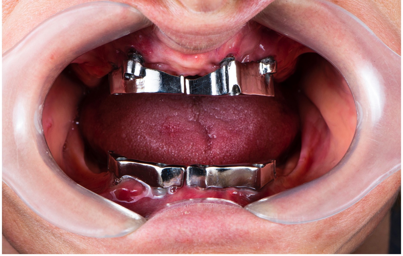 full mouth rehabilitation by crowns veneers and implantsfull mouth rehabilitation by crowns veneers and implants