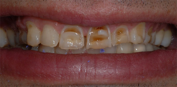 10 Custom Porcelain Veneers