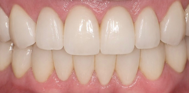Upper-and-Lower-Veneers-After