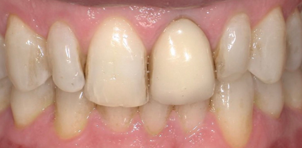Upper-and-Lower-Veneers-Before
