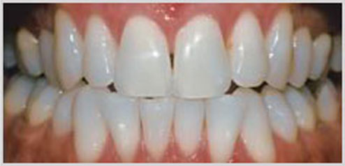 teeth-whitening-after-1