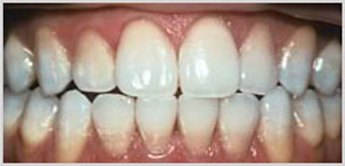 teeth-whitening-after-2