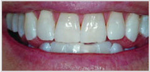 teeth-whitening-after-3