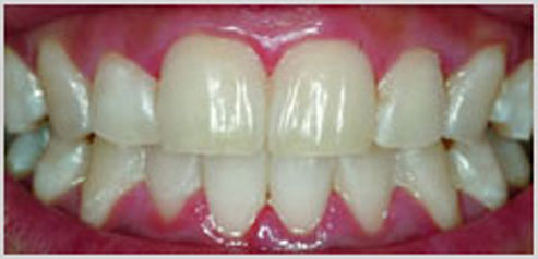 teeth-whitening-after-4