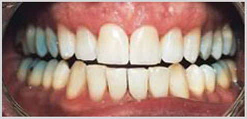 teeth-whitening-after-5