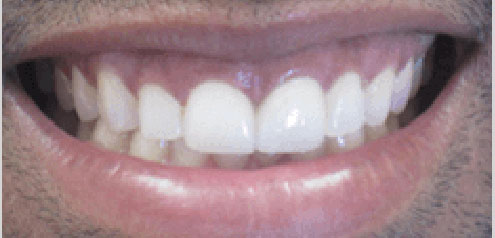 teeth-whitening-after-6