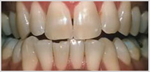 teeth-whitening-before-1