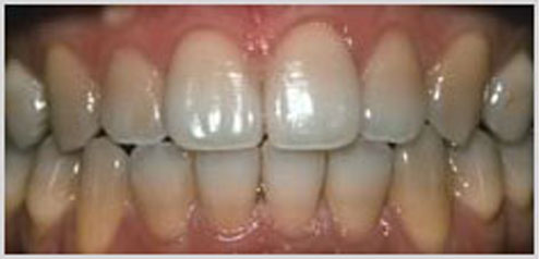 teeth-whitening-before-2
