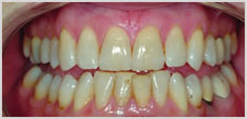 teeth-whitening-before-3