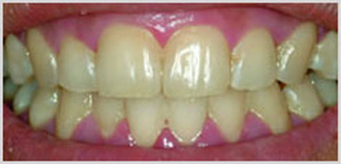 teeth-whitening-before-4