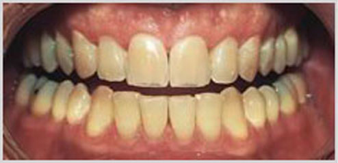 teeth-whitening-before-5