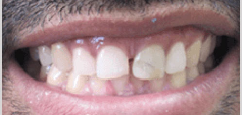 teeth-whitening-before-6